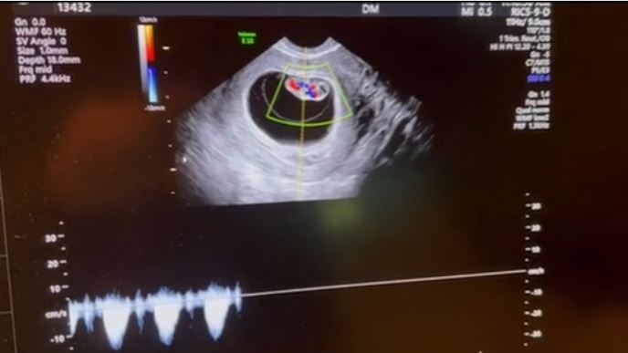 Адриана Лима е бременна с третото си дете (ВИДЕО)