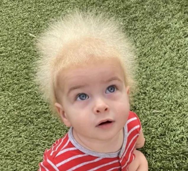 Момченце с рядък синдром удиви света с косата си (ВИДЕО)