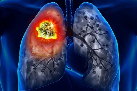 „Инвестирайте, за да спрете туберкулозата. Спасете живот!“