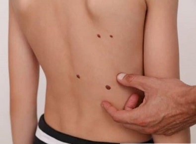 Безплатни прегледи за рак на кожата