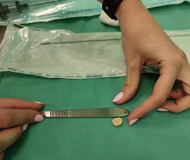 В Бургас спасиха дете със заседнал в трахеята зъб