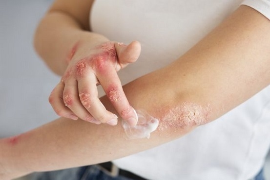 Безплатни прегледи за тежък атопичен дерматит