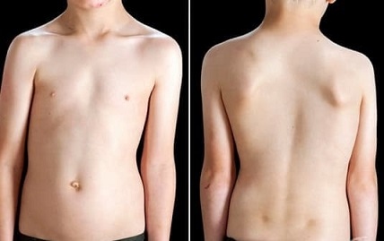 Преглеждат безплатно деца за сколиоза в Търговище