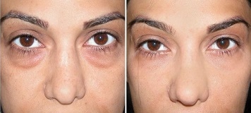 Маска от картофи и магданоз маха торбичките под очите