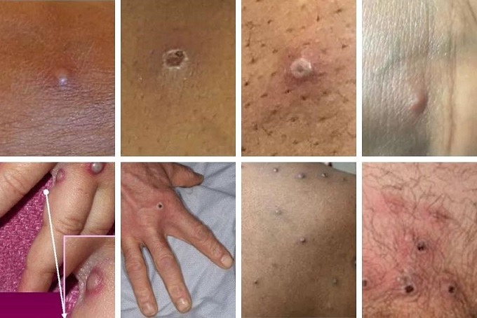 Първи случай на маймунска шарка в Европа