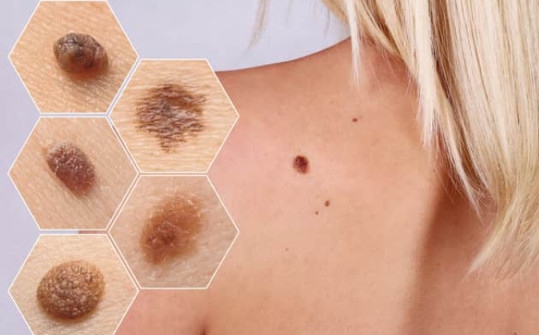 Бенките – кога са сигнал за тревога