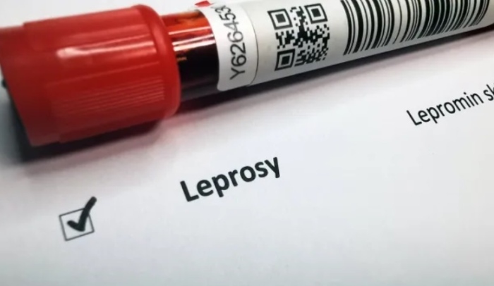 Случай на проказа вече и в Хърватия