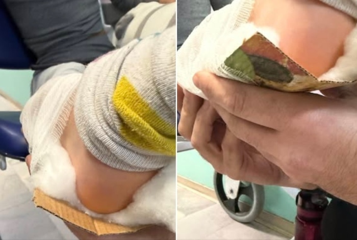 Шинираха счупен крак с картон от кутия за пица