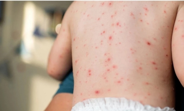 Реален риск за епидемия от морбили