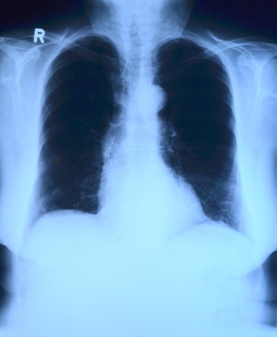 Клетъчна реакция в белите дробове в резултат на COVID-19 Учени обясняват с нея трудното лечение на болестта. Следвай ме - Здраве